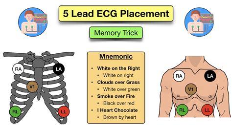 5 lead electrode placement diagram.